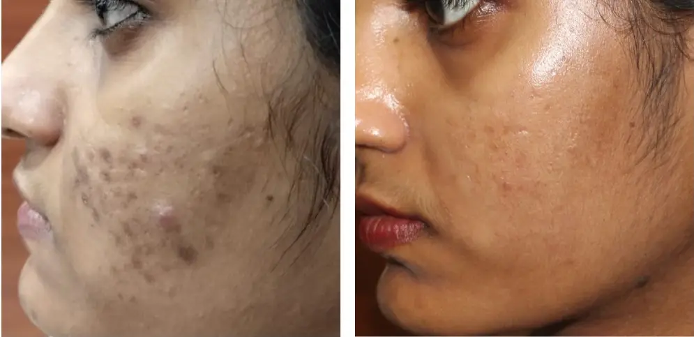 Acne & pigmentation care