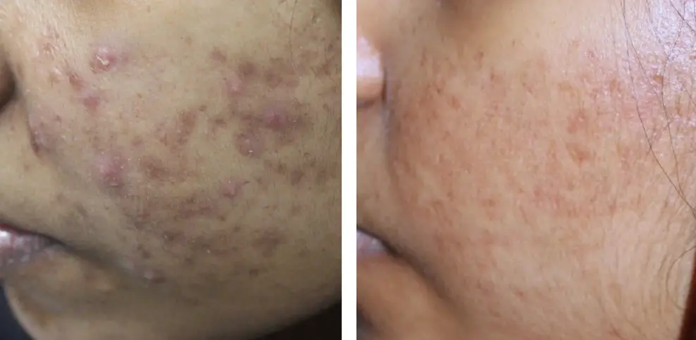 Dermatological skin care