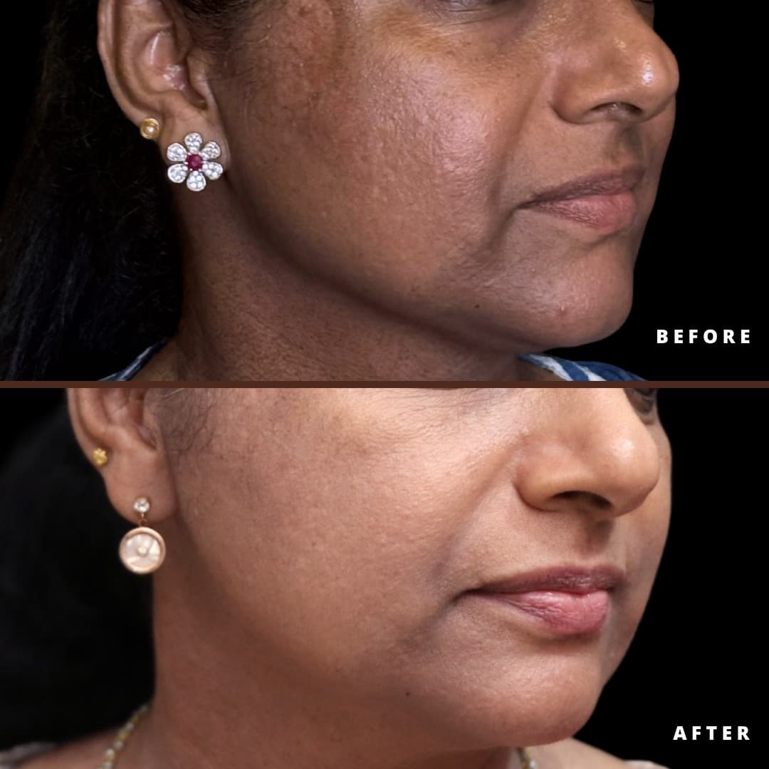 Skin tone brightening & radiance