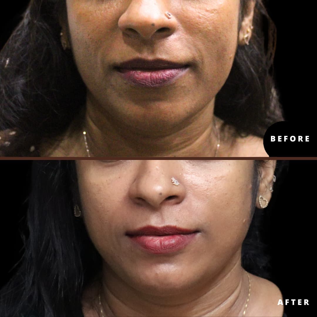 Pigmentation & spot reduction