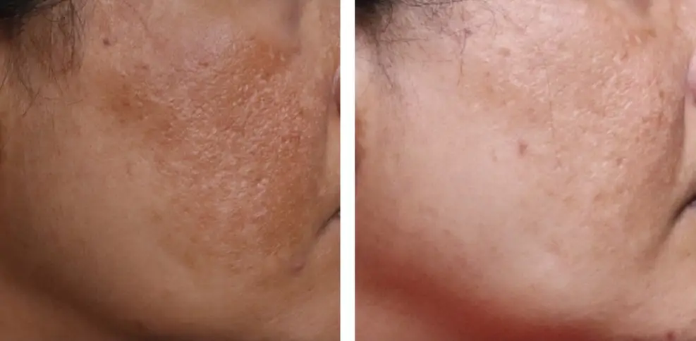 HydraFacial skin rejuvenation results