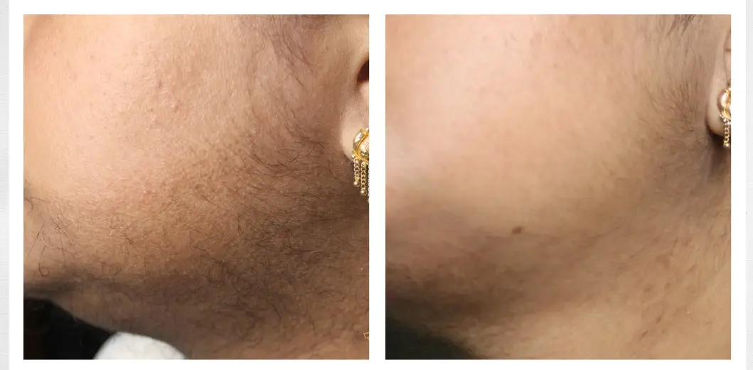 Laser hair reduction results