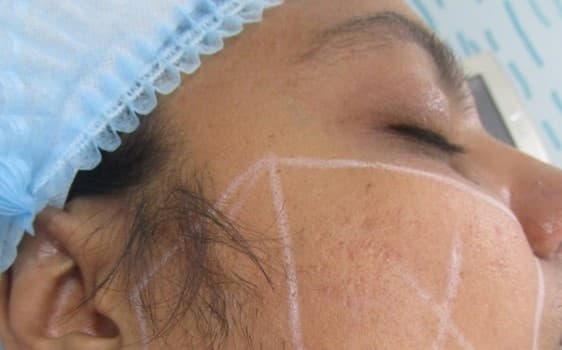 Before, Pre-event radiance & tone brightening