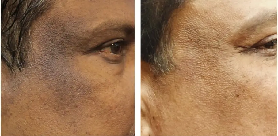 Skin treatment results
