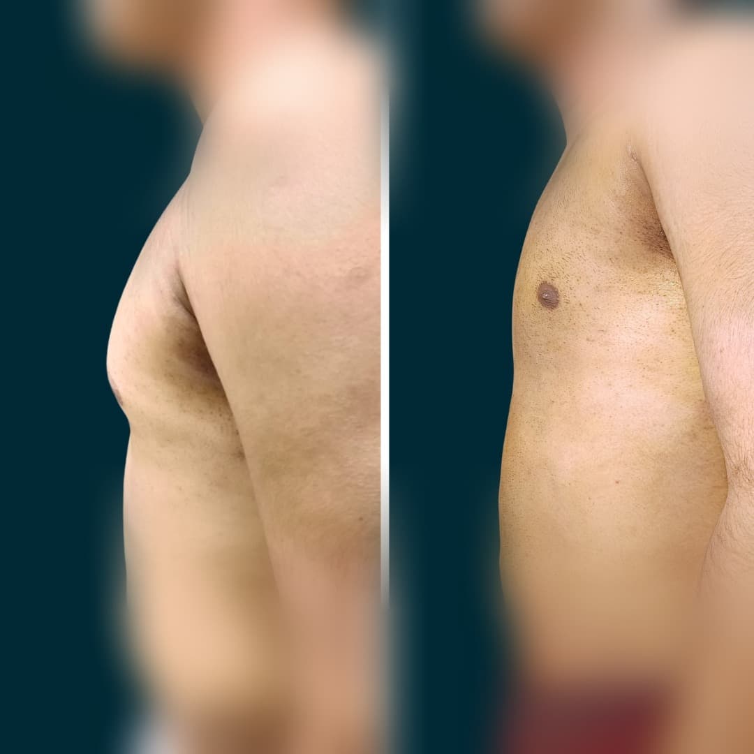 Abdomen & waist VASER contouring