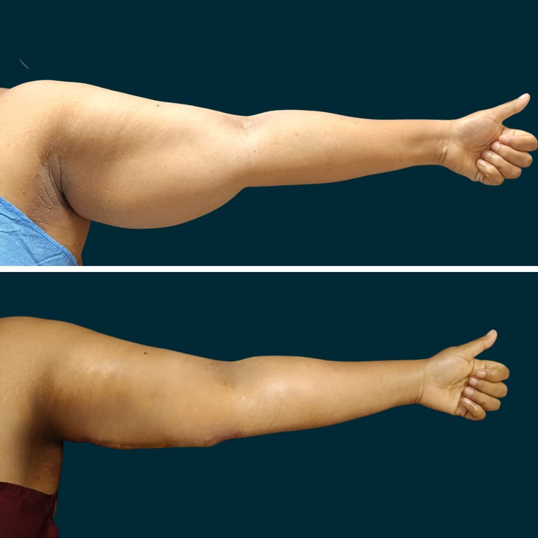 Full body & flank VASER contouring