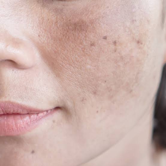 Pigmentation