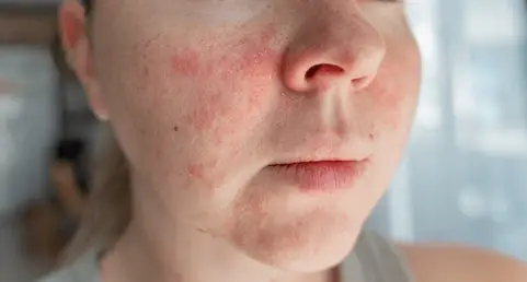 Uneven skin tone