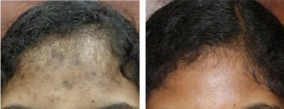 Hair restoration & regrowth results