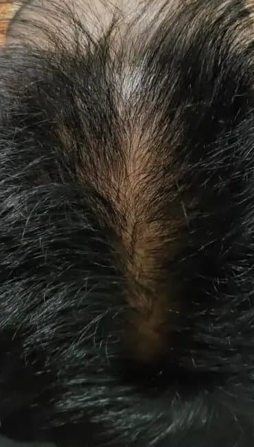 After, Hair fall treatment