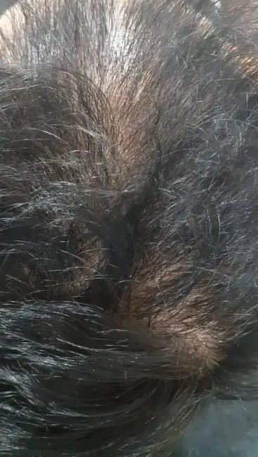 Before, Hair fall treatment