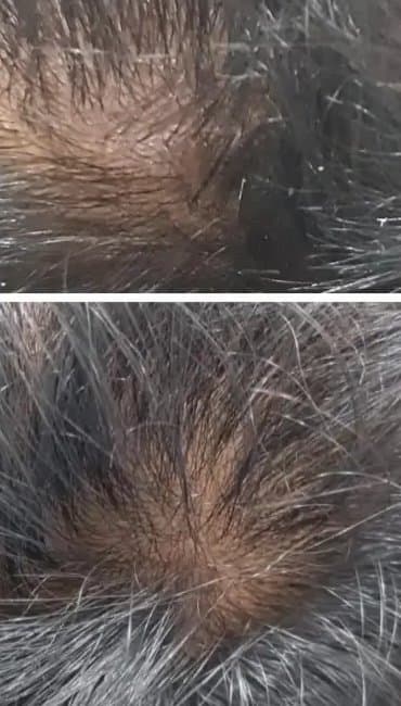 After, Hair density improvement