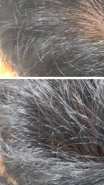 Before, Hair density improvement
