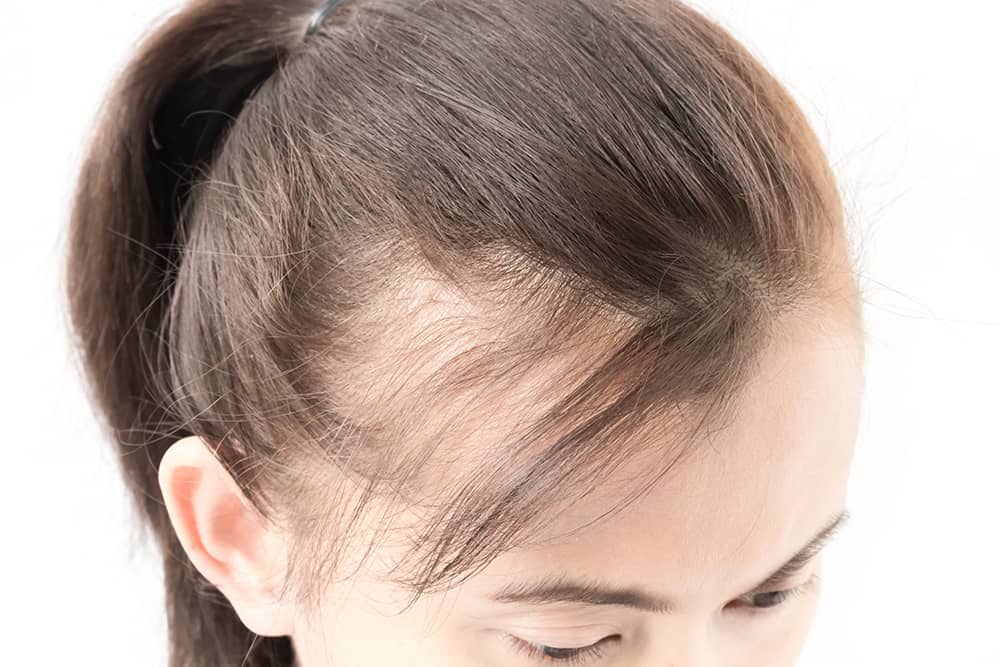 Hair Thinning